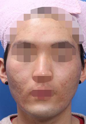杭州隆鼻医生杨海波的整形术后图片