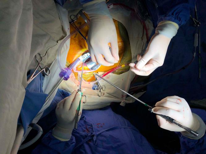 胸腔镜辅助下心外科手术