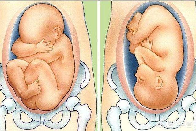 胎心在孕妇肚脐上下方多数是胎位不正胎位正胎心在这个位置