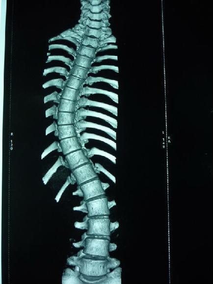 特发性脊柱侧凸-典型病例 - 好大夫在线