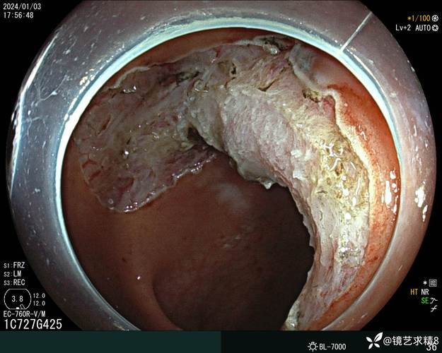 直肠巨大管状绒毛状腺瘤1例