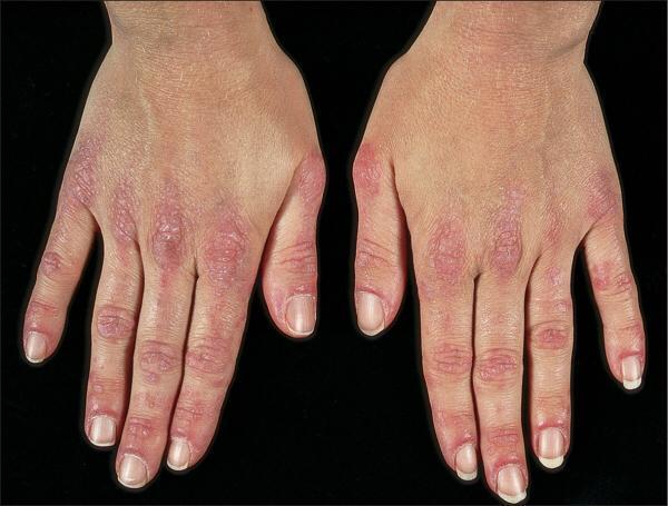 "手背手指和指甲周围特征性的紫红斑,还可以看到的毛细血管扩张"