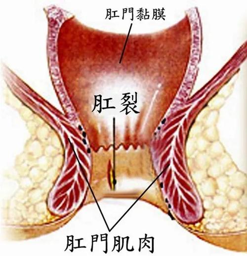 肛门外括约肌从两侧包绕肛管,至使肛管侧方肌肉丰厚而前后方薄弱,加之