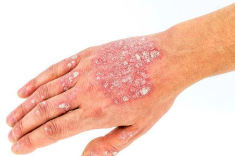 粉末状鳞屑图碎瓷样皮损图干性湿疹表现为皮脂分泌减少,干燥,表皮及