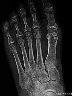 被严重低估的小骨头:有一种脚掌疼,叫籽骨受伤,很多人不知道