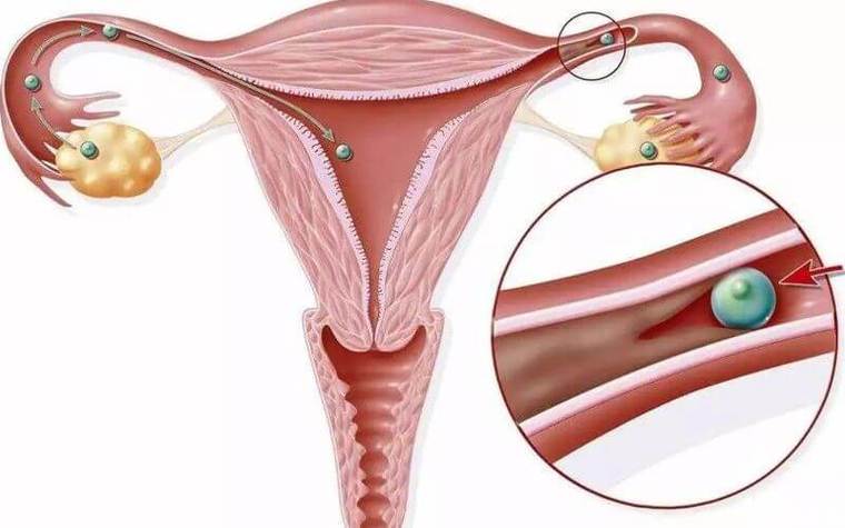 由于多次人工流产或刮宫,导致的子宫内膜基底层损伤,从而导致宫腔粘连