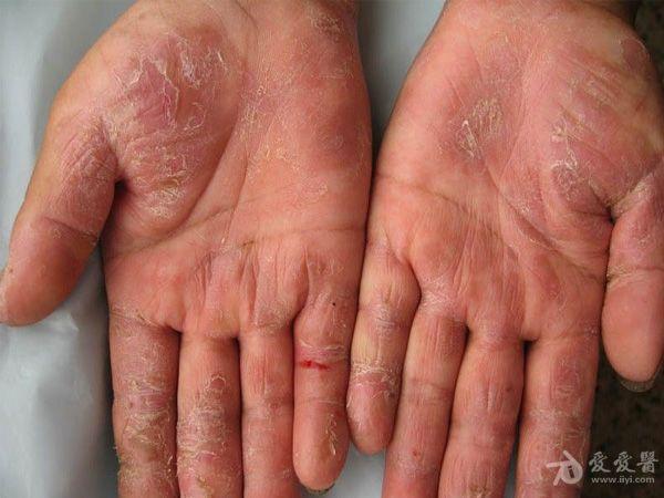 手湿疹和手癣的鉴别诊断