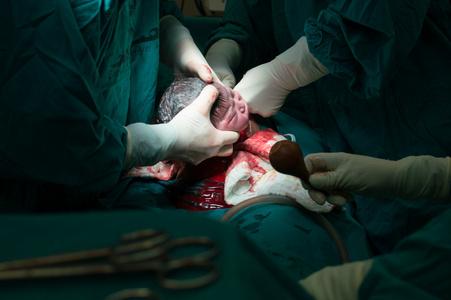 剖宫产新出生的婴儿新生儿手术室新出生的婴儿新生的孩子秒和分钟后新