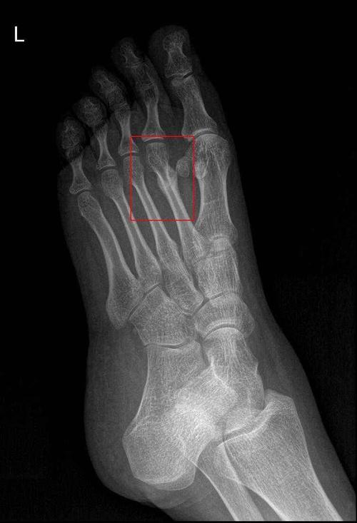 红框标注处,左足第2跖骨陈旧性骨折,骨折线已基本愈合,断端对位对线好