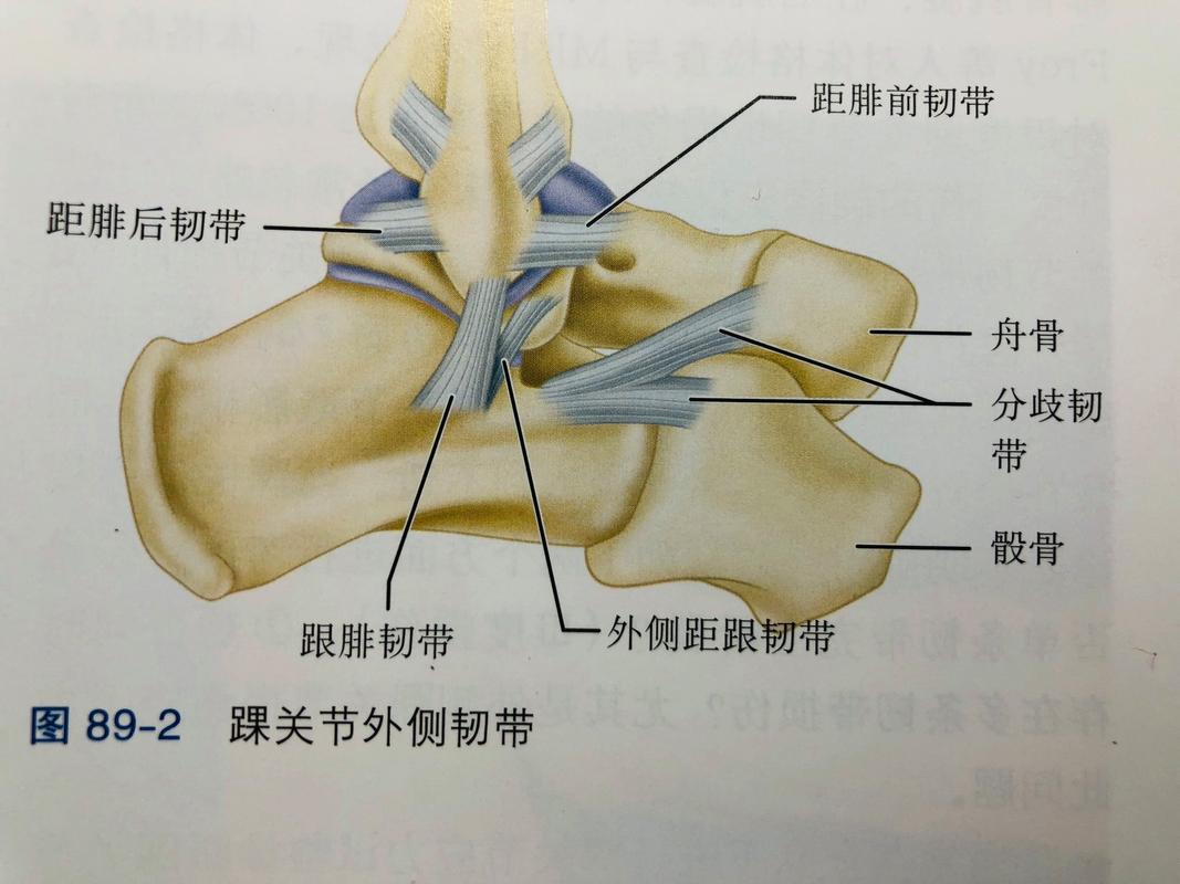外侧副韧带最易损伤(百分之九十以上)一,踝扭伤病理特征(韧带,骨性)