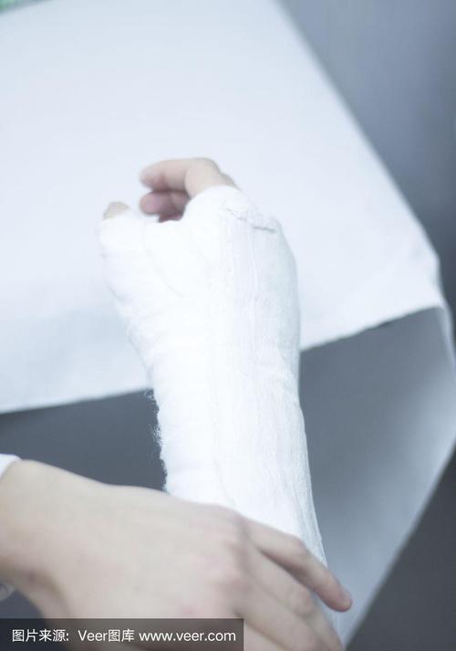 骨折后,医生在患者前臂和手腕上使用石膏石膏和绷带固定.