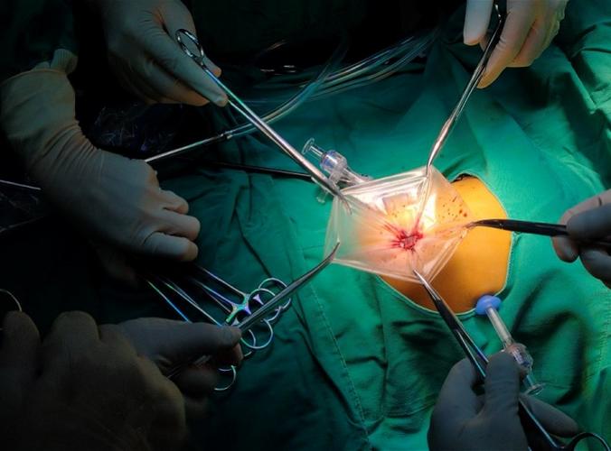 1岁宝宝腹腔内装上"红绿灯",指引医生精准切除巨大肝母细胞瘤