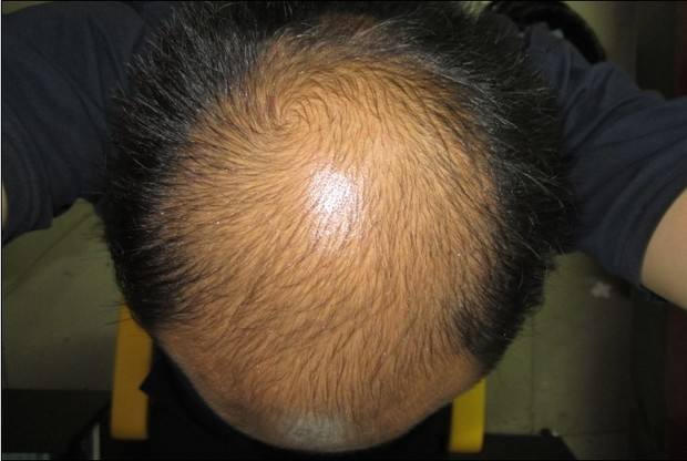 脂溢性脱发怎么恢复生发的最好方法