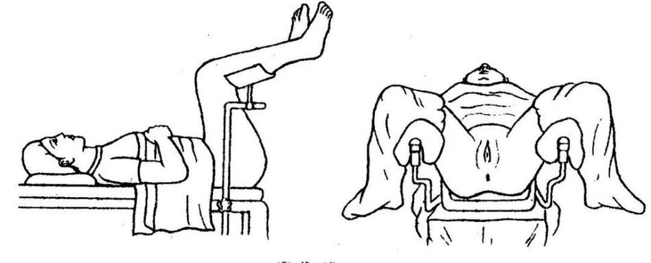 患者妇科检查时,要采取膀胱截石位,医师面向患者,站立于患者两腿间.