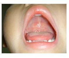 各种球菌常侵犯婴幼儿,引起口腔炎,又称溃疡性口疮.