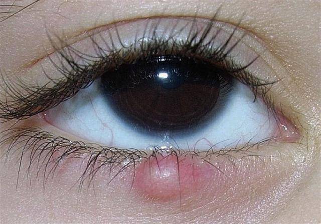 眼睑上长出黄色的脂肪粒时要注意了,小心要得病