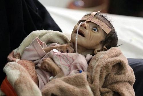 图为也门一个因营养不良而早夭的5个月大的婴儿(图片来源:腾讯新闻)