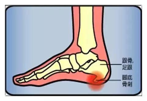是足跟痛最常见的原因之一,往往发生在长期站立或行走工
