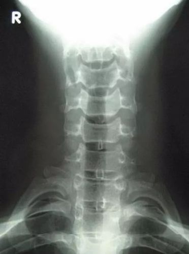 x光正位样片(2)侧位曲度的改变颈椎发直,生理前突消失或反弯曲.