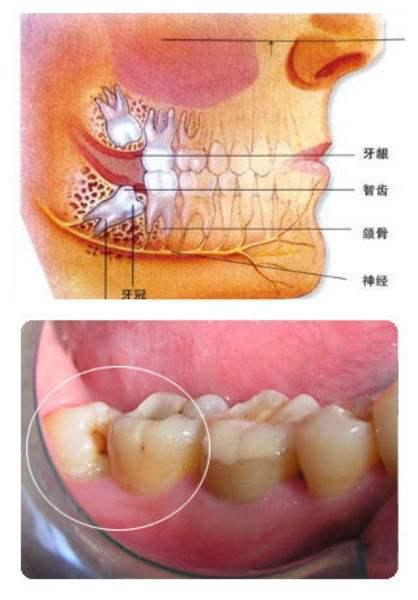 阻生齿最常见于下颌第三磨牙,俗称智齿,此牙萌出年龄在18岁前后,由于
