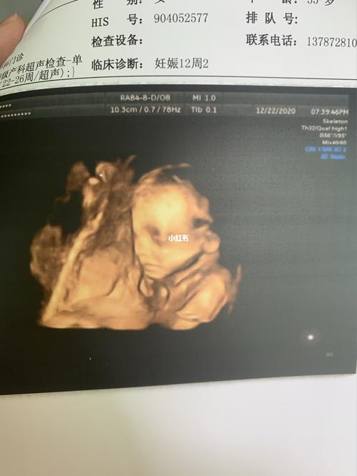 怀孕35周孩子在肚子的右侧动的图片三十五周胎儿真实图片平躺胎儿在