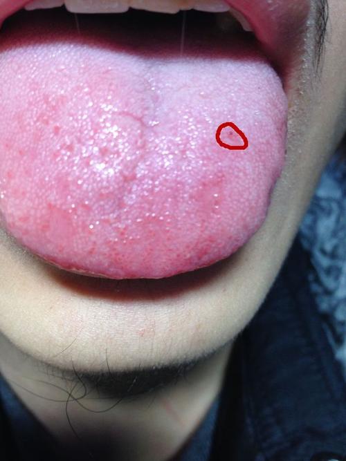 舌苔有一个小红点就是我画起来的这红点这到