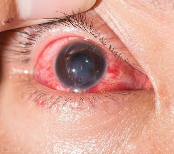 科普红眼病真的是看一眼就会被传染吗