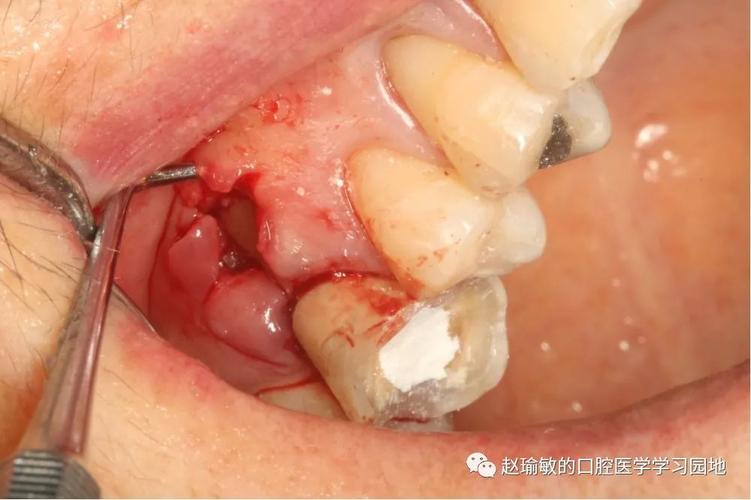 急性牙髓炎牙槽骨吸收牙根暴露一例