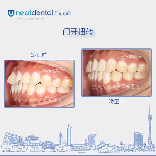 广州隐形矫正杨露医生:牙齿不齐,门牙扭转,面部美学的正畸案例分享