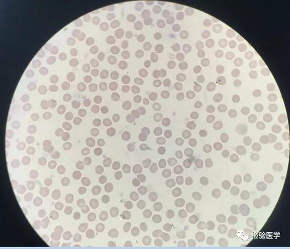 孵育前显微镜下根据以上信息初步判断此标本属于红细胞冷凝集