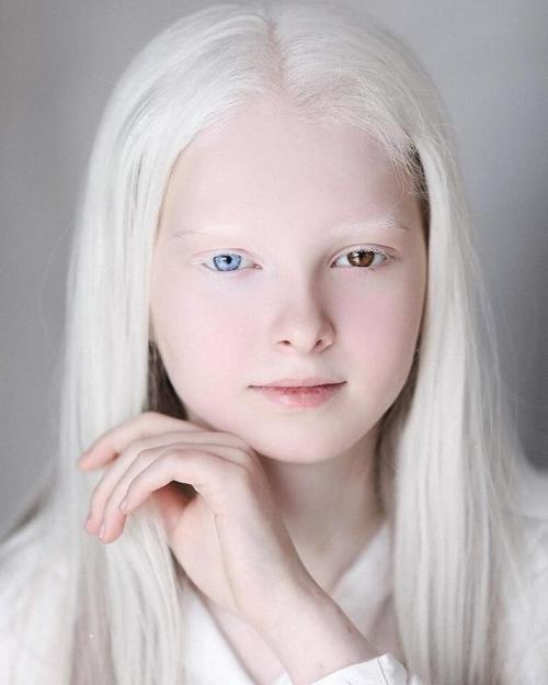 11岁美丽女孩天生白化病和异色瞳,美得像精灵,仿佛来自二次元!