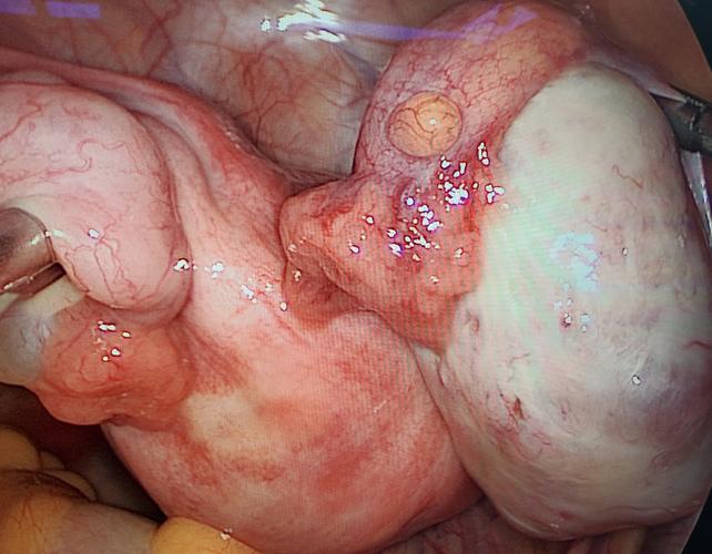 卵巢多发性畸胎瘤