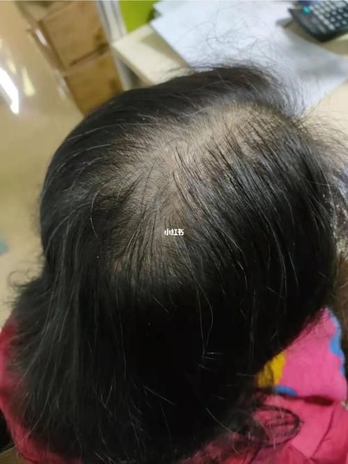 女性遗传性脱发2个月效果