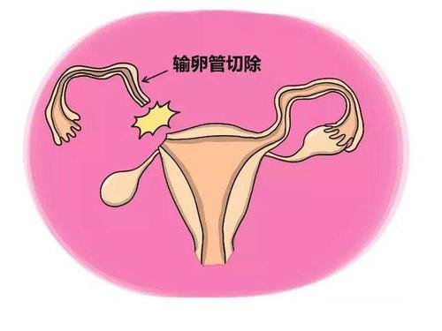 输卵管双侧堵塞做宫腹腔镜手术疏通的成功率大吗