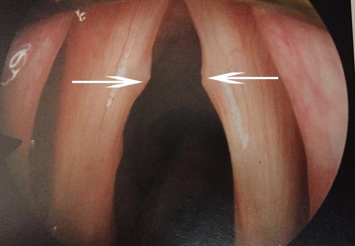 喉镜检查可见声带前中1/3交界处局限性黏膜肿胀或结节样突出(见图1)