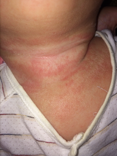 宝宝脖子上有一圈红疹,念珠菌感染 - 过敏宝宝 - 妈妈帮
