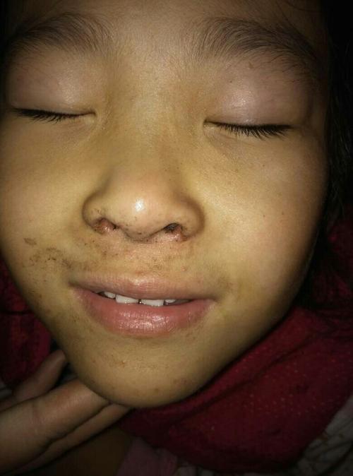 外甥女的鼻孔发红,干涩,有一段时间了,一直涂的舒急宝宝药膏,也没有
