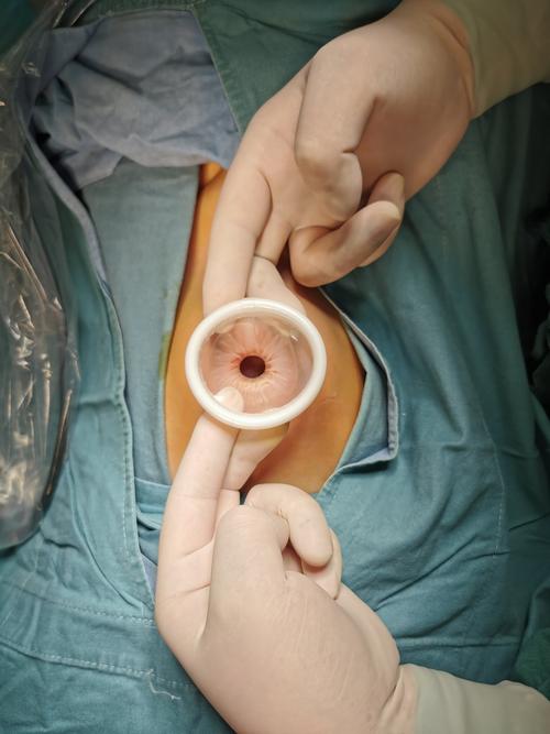 从肚脐切开一个小口,所有的器械从这个小口进入腹腔就行操作,完成手术