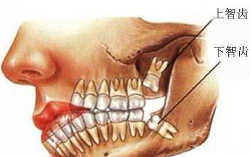 一般来说,脸瘦小的,v型的,尖下巴的人,由于横向不够宽,牙槽骨空间相对