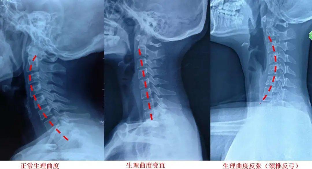 反弓的形式出现,所以在很多颈椎患者进行颈椎x光片检查的时候会有