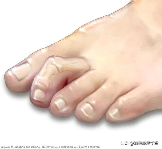 槌状趾,锤状趾是脚趾肌肉,肌腱或韧带失衡引起的脚部畸形.