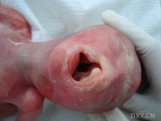 【共享】典型胎儿引产后图片