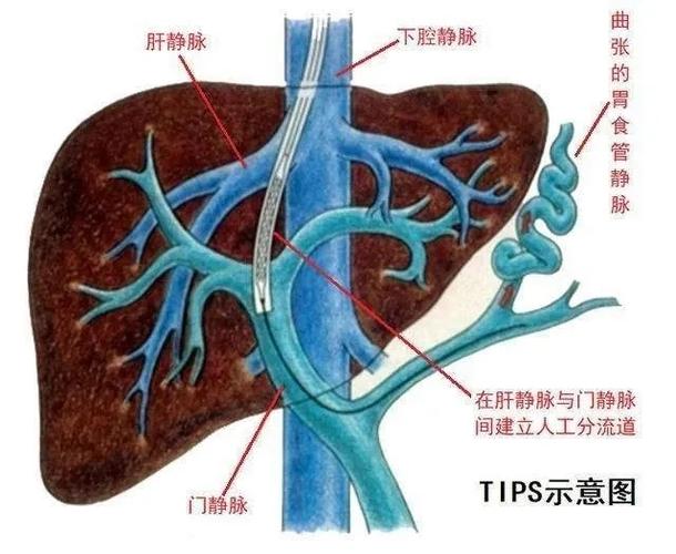 腔静脉分流术(tips)除了用来治疗门静脉高压食管胃静脉曲张破裂出血外