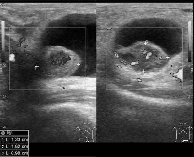 图 1 -图 3:超声检查可见小肠疝出,其周围可见积液,疝出肠管可见血流