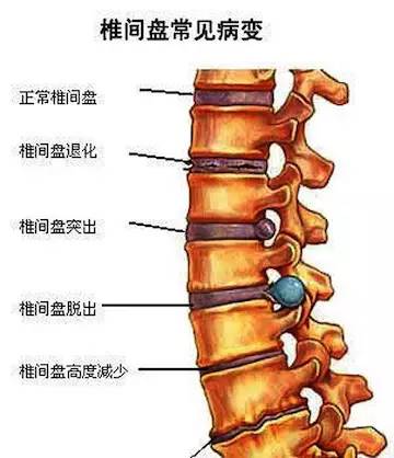大多数侧弯cobb角 60°,常伴随有腰椎前凸减少,椎体侧方滑移及椎管或