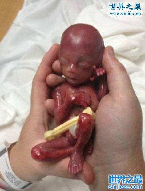 二,阿米利娅,存活下来的世界上最小的婴儿