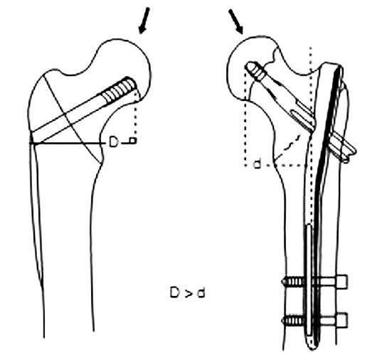 股骨粗隆间骨折的内固定物选择