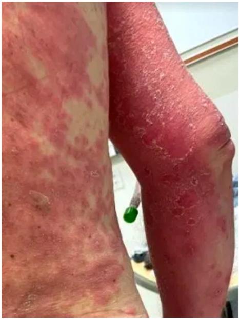 最严重的时候,皮肤异常脱落,皮疹蔓延至全身,呈现出一片血红色!