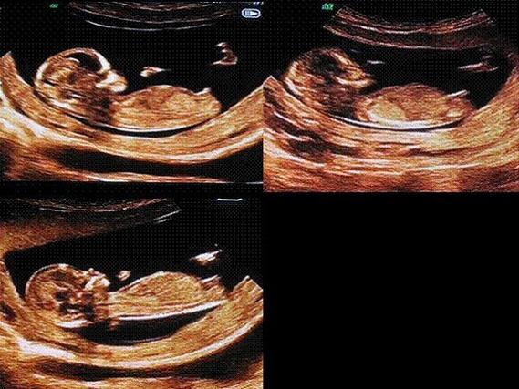 孕12周胎儿小鸡彩超图分享,两腿间有凸起是男孩不可信