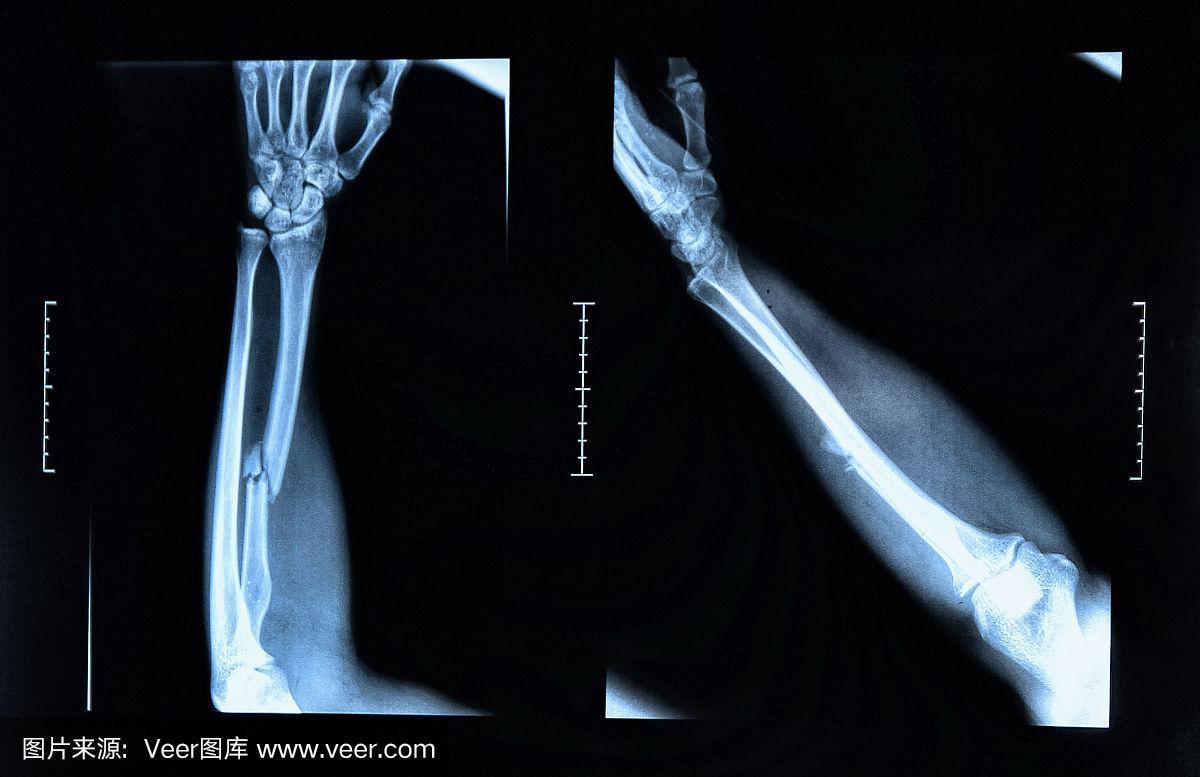x光片显示手臂骨折